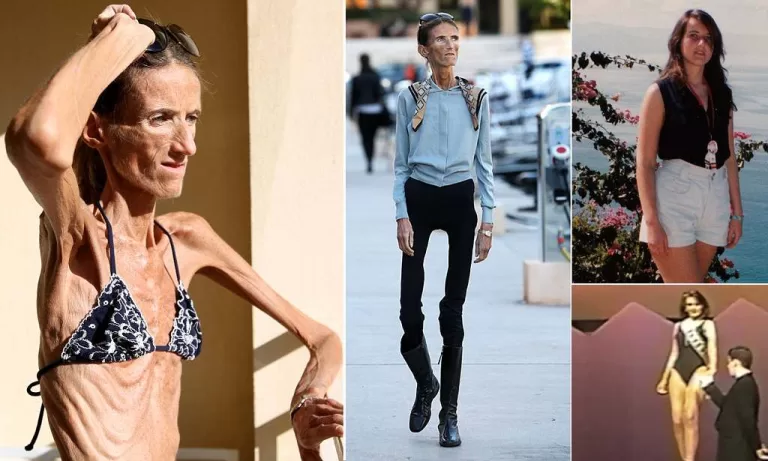 The World’s Thinnest Woman’s Battle Against Anorexia Will Leave You Speechless!