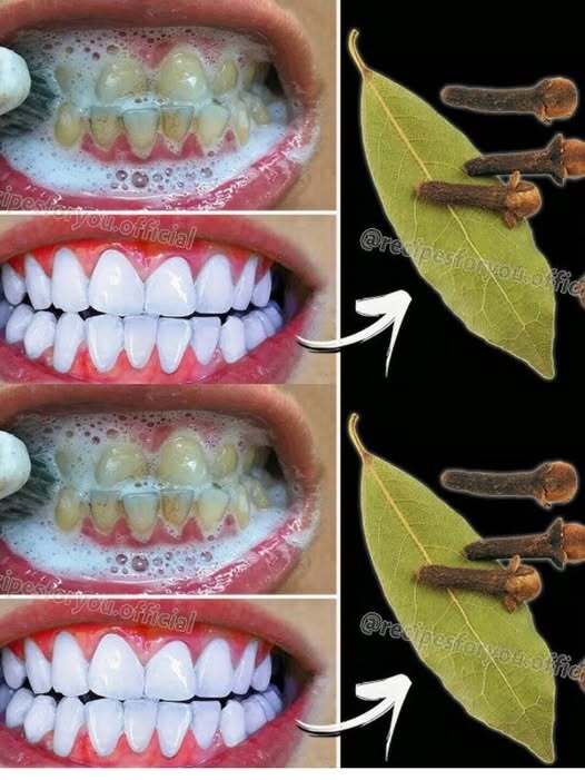 Brightening teeth with bay leaves has gained attention as a natural remedy for yellowing teeth, but many wonder whether it truly works or is simply a myth. Supporters claim bay leaves can help remove surface stains and freshen breath, while skeptics point out the lack of scientific evidence. Understanding its benefits, limitations, and proper dental care is essential.