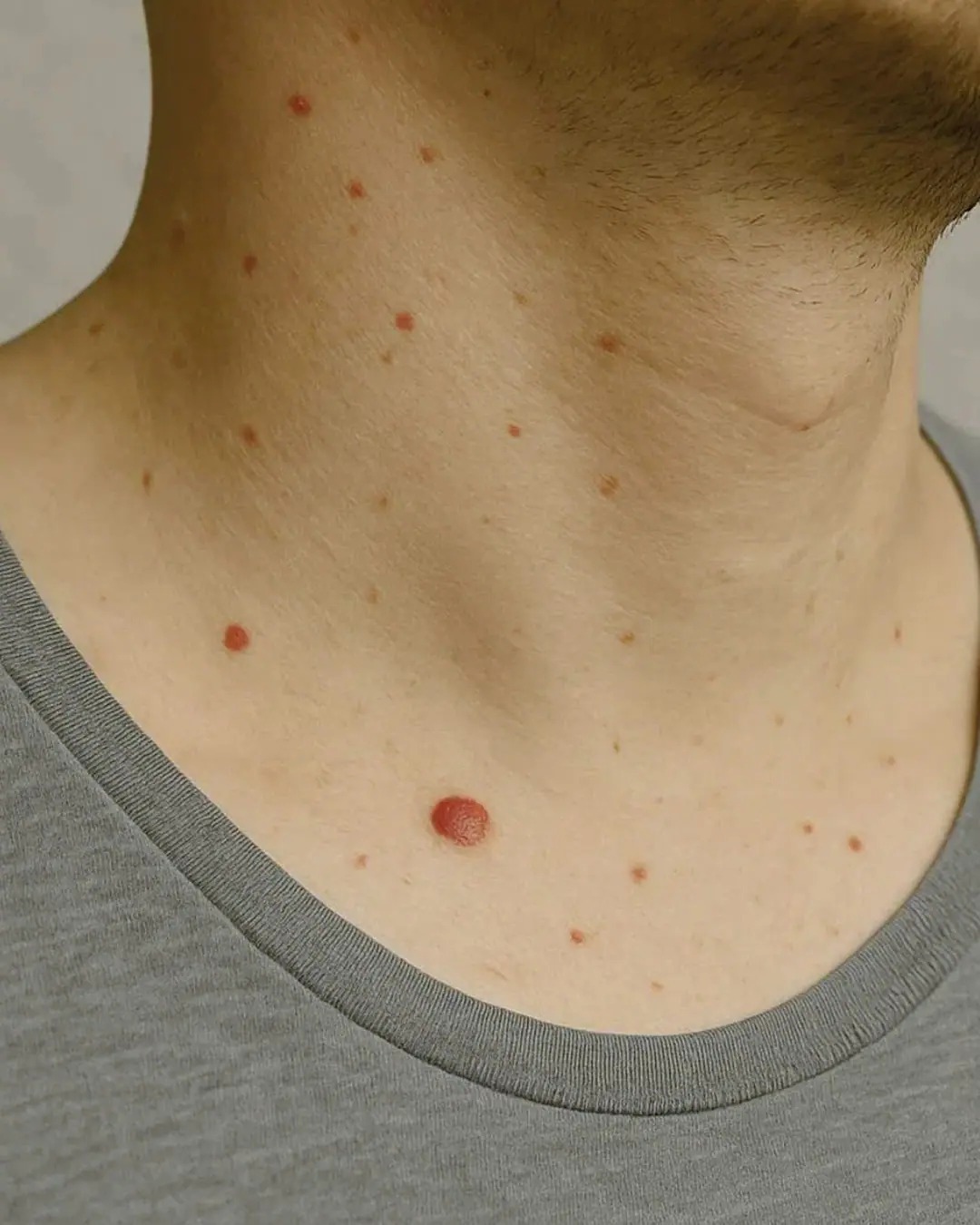 Have you suddenly discovered a tiny scarlet mark on your skin? Don’t panic: these cherry angiomas, while surprising, are generally harmless. Discover how to prevent their appearance with simple habits, especially dietary ones.