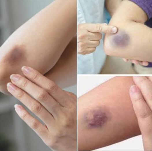 BE CAREFUL, if you get these bruises on your body, here’s what it means