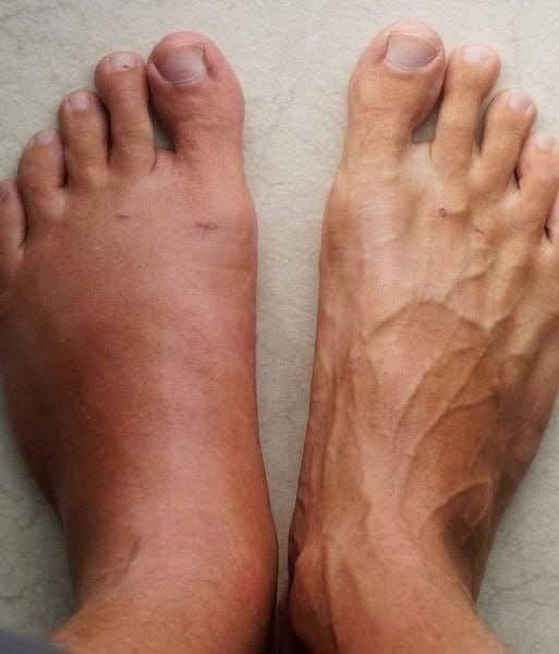 One Month Before a Heart Attack, Your Body Will Alert You: Here Are the 6 Symptoms!