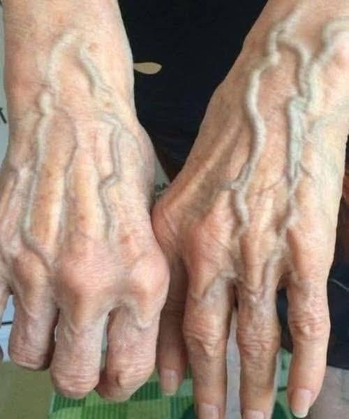 What the Veins on Your Hands Might Reveal About Your Heart Health